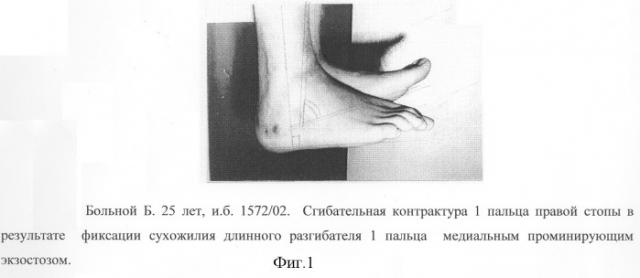 Способ оперативного лечения осложненного перелома пяточной кости (патент 2301032)