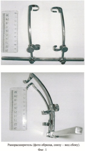 Ранорасширитель шейный (патент 2457798)