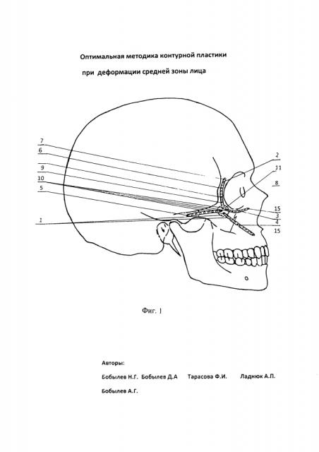 Оптимальная методика контурной пластики при деформации средней зоны лица (патент 2599864)