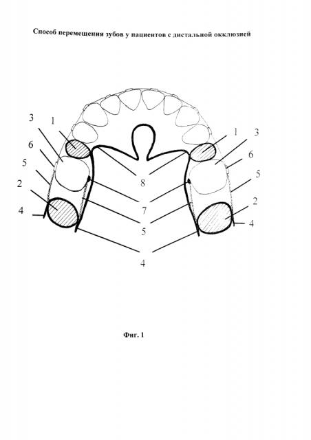 Способ перемещения зубов у пациентов с дистальной окклюзией (патент 2641000)