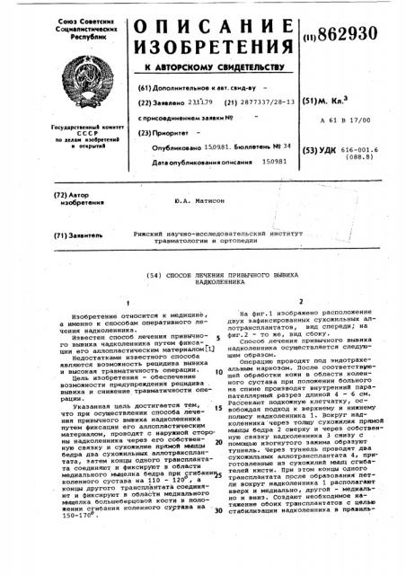 Способ лечения привычного вывиха надколенника (патент 862930)