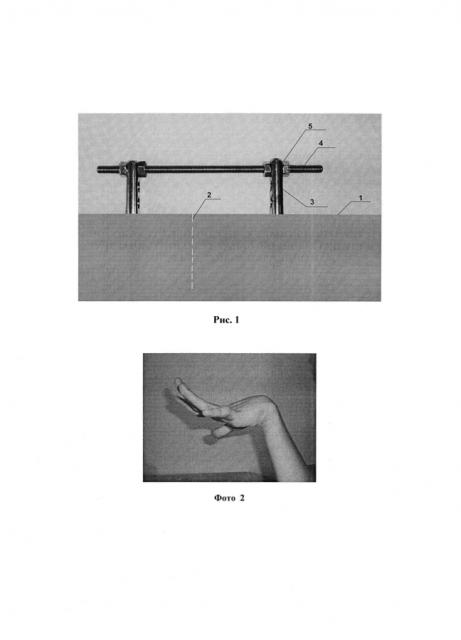 Способ устранения сгибательной контрактуры лучезапястного сустава у больных с детским церебральным параличом (патент 2593743)