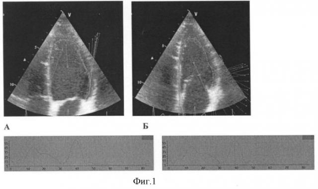 Способ диагностики недостаточности сократительной функции миокарда (патент 2354301)