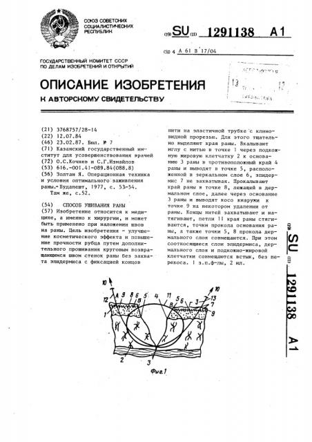 Способ ушивания раны (патент 1291138)