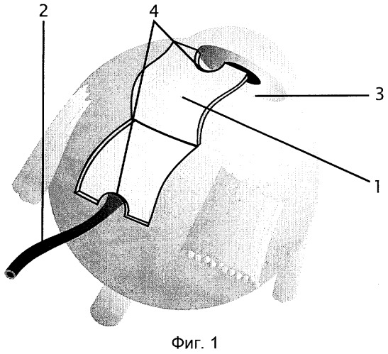 Способ хирургического лечения сосудистых заболеваний внутренних оболочек глаза (патент 2289371)
