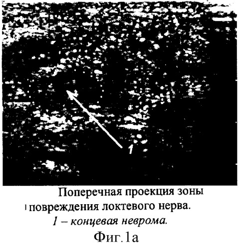 Способ ультразвуковой диагностики перерыва срединного и локтевого нервов на уровне предплечья и контроля их регенерации после шва (патент 2254808)