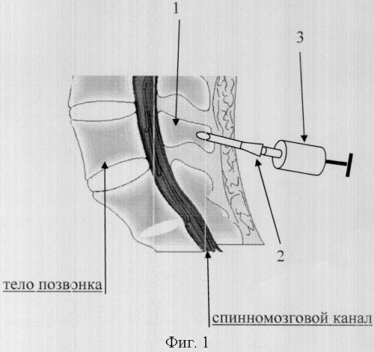 Способ моделирования остеохондроза в эксперименте (патент 2301458)