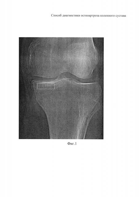 Способ диагностики остеоартроза коленного сустава (патент 2644541)