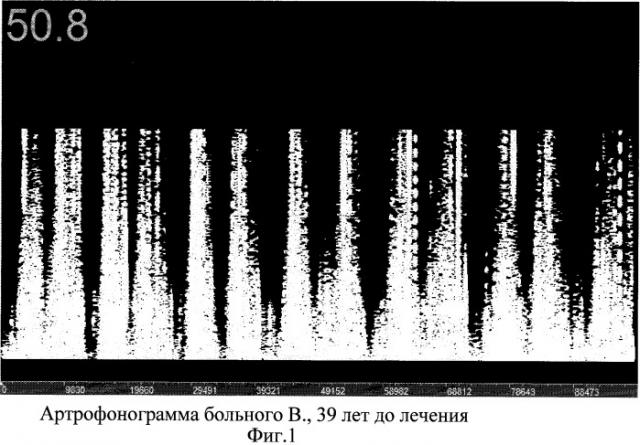 Способ лечения посттравматического деформирующего остеоартроза (патент 2384352)