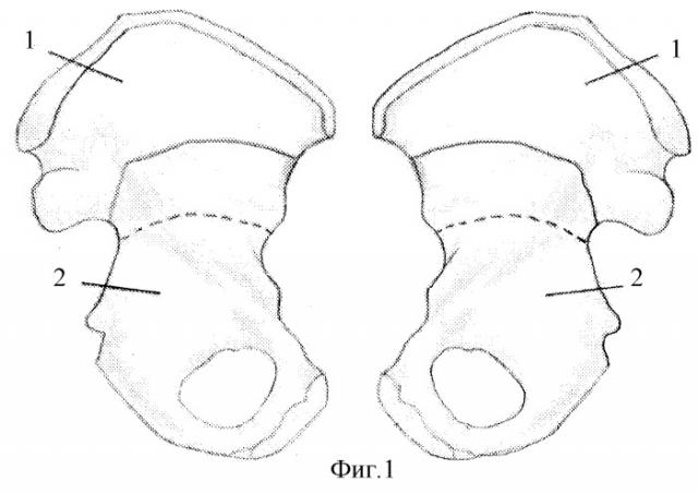 Способ хирургического лечения двухсторонней дисплазии тазобедренного сустава (патент 2269960)