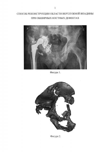 Способ реконструкции области вертлужной впадины при обширных костных дефектах (патент 2656522)