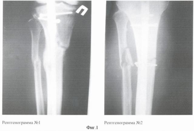 Способ лечения многооскольчатых и множественных переломов длинных трубчатых костей (патент 2370227)