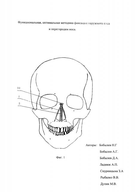 Способ фиксации наружного носа и перегородки полости носа. (патент 2626125)