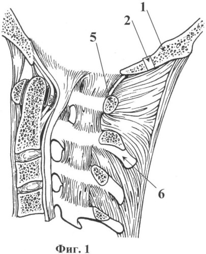 Способ фиксации шейно-затылочной области позвоночника (патент 2342915)