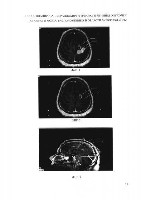 Способ планирования радиохирургического лечения опухолей головного мозга, расположенных в области моторной коры и/или прилегающих к данной области (патент 2655880)