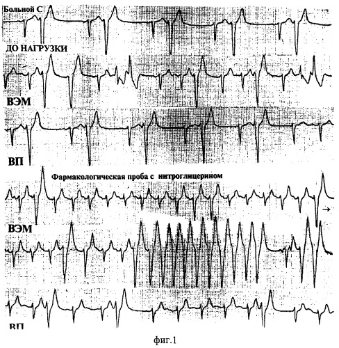 Способ диагностики ишемических желудочковых нарушений ритма у больных ишемической болезнью сердца (патент 2280402)