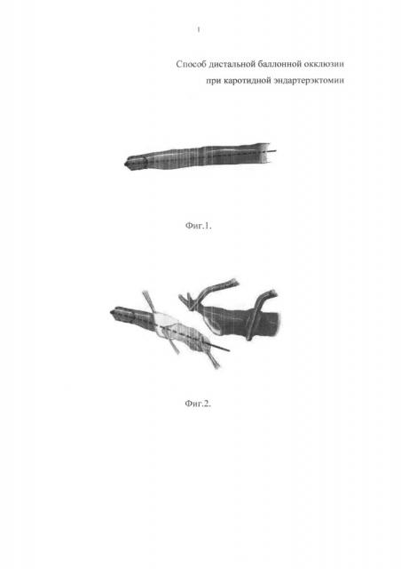 Способ дистальной баллонной окклюзии при каротидной эндартерэктомии (патент 2639802)