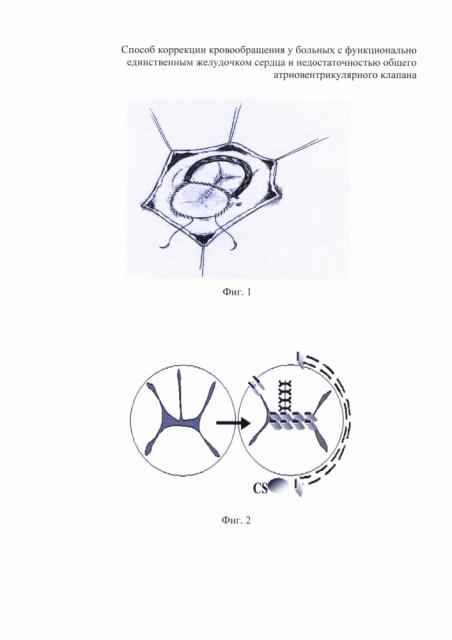 Способ коррекции кровообращения у больных с функционально единственным желудочком сердца и недостаточностью общего атриовентрикулярного клапана (патент 2618648)