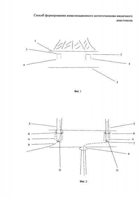 Способ формирования инвагинационного мочеточниково-кишечного анастомоза (патент 2597773)