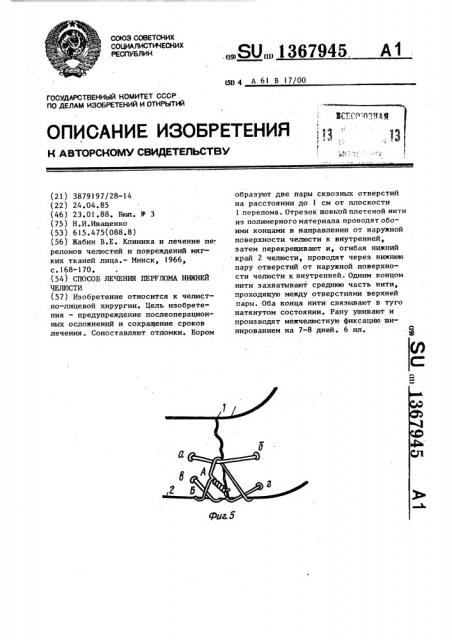 Способ лечения перелома нижней челюсти (патент 1367945)