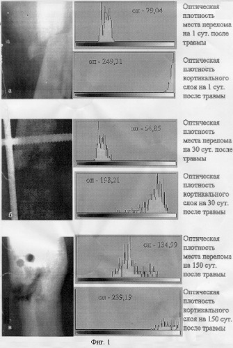 Программно-цифровой способ определения степени сращения переломов костей (патент 2255656)