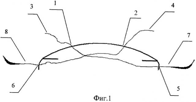 Способ репозиции дислоцированной интраокулярной линзы в цилиарную борозду (варианты) (патент 2393826)