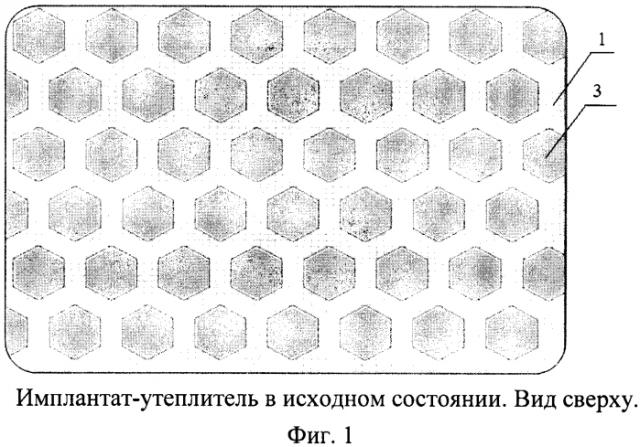 Краниальный имплантат-утеплитель (патент 2579744)