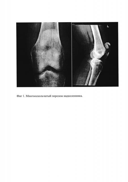 Способ остеосинтеза при многофрагментарных оскольчатых переломах надколенника (патент 2615665)