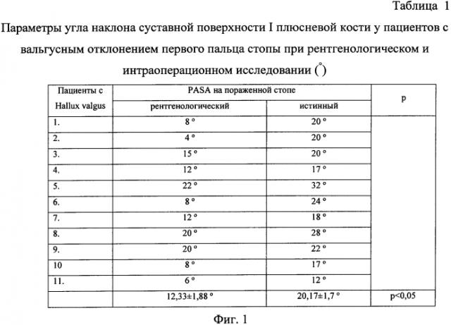 Способ определения наклона суставной поверхности головки первой плюсневой кости стопы (патент 2567825)