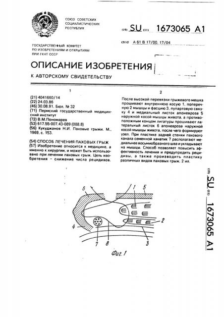 Способ лечения паховых грыж (патент 1673065)