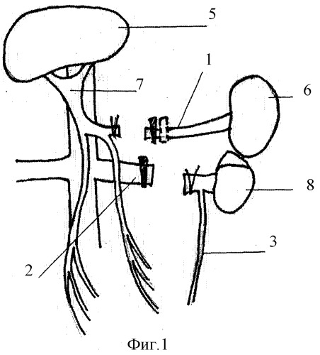 Способ лечения портальной гипертензии (патент 2321360)