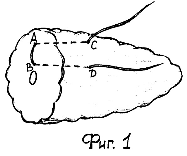 Способ формирования культи поджелудочной железы при наложении панкреатоеюноанастомоза (патент 2256413)