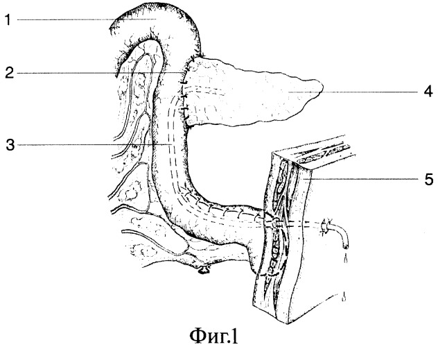 Способ завершения панкреатодуоденальной резекции при неизмененной ткани поджелудочной железы (патент 2272576)