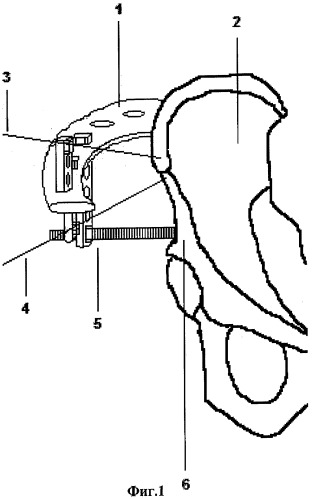 Способ наложения тазовой дуговой опоры аппарата илизарова при лечении заболеваний тазобедренного сустава (патент 2321368)
