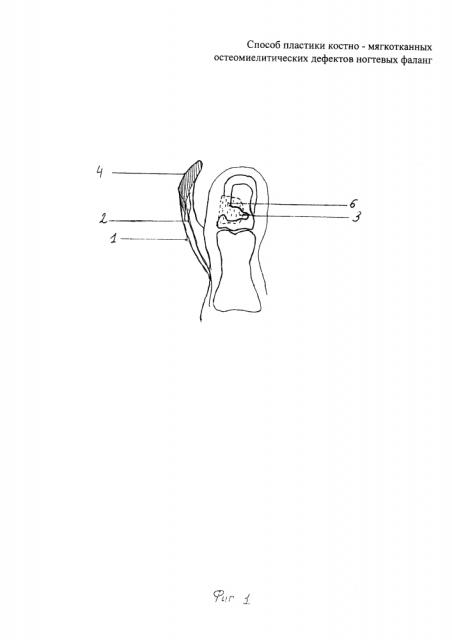 Способ пластики костно-мягкотканных остеомиелитических дефектов ногтевых фаланг (патент 2634421)