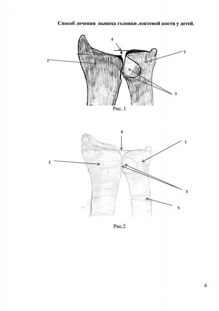 Способ лечения вывиха головки локтевой кости у детей (патент 2647178)