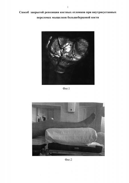 Способ закрытой репозиции костных отломков при внутрисуставных переломах мыщелков большеберцовой кости (патент 2625651)