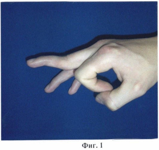 Способ лечения разгибательной контрактуры пальца в проксимальном межфаланговом суставе (патент 2464947)