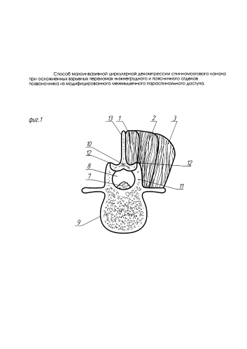 Способ малоинвазивной циркулярной декомпрессии спинномозгового канала при осложненных взрывных переломах нижнегрудного и поясничного отделов позвоночника из модифицированного межмышечного параспинального доступа (патент 2592779)