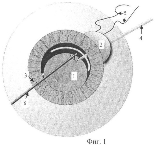 Способ устранения дислокации интраокулярной линзы (патент 2462213)