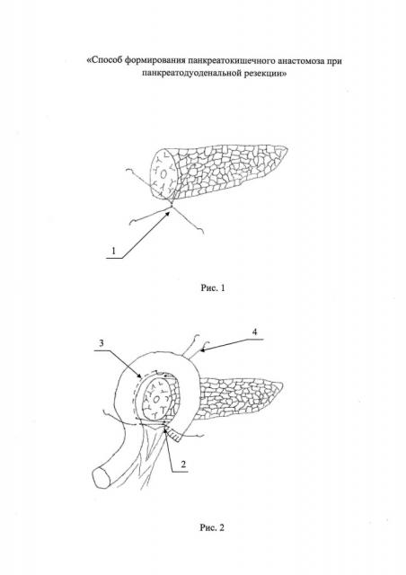 Способ формирования панкреатокишечного анастомоза при панкреатодуоденальной резекции (патент 2632767)