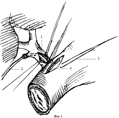 Способ хирургического лечения протяженных стриктур дистального отдела холедоха (патент 2401647)