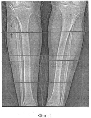 Способ определения локальной плотности корковой пластинки длинных костей (патент 2539424)