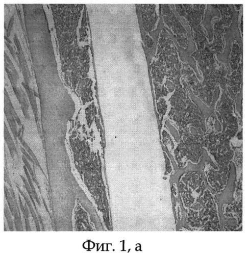 Способ проведения стабильного остеосинтеза при повреждениях костной ткани (патент 2523553)