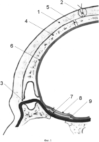 Способ реконструкции обширных дефектов дна передней черепной ямки (патент 2570619)