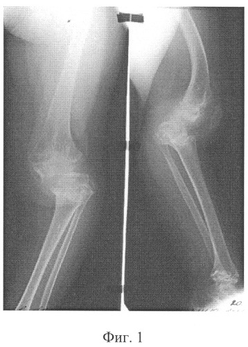 Способ лечения больных с деформациями нижних конечностей при метаэпифизарной дисплазии (патент 2321367)