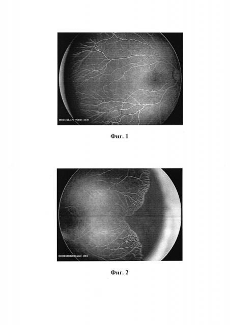 Способ прогнозирования течения i-iii стадий активной ретинопатии недоношенных на основании данных флюоресцентной ангиографии (патент 2666268)