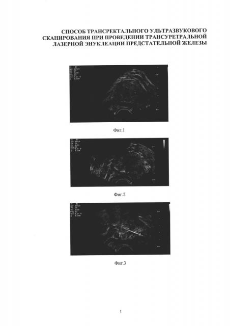 Способ трансректального ультразвукового сканирования при проведении трансуретральной лазерной энуклеации предстательной железы (патент 2610916)