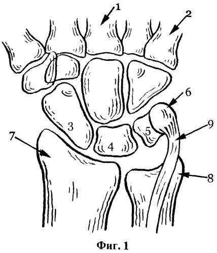 Способ артродеза лучезапястного сустава у детей с вялыми параличами верхней конечности (патент 2463984)