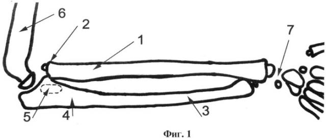 Способ артродеза проксимального лучелоктевого сочленения у детей с вялыми параличами верхней конечности (патент 2492833)